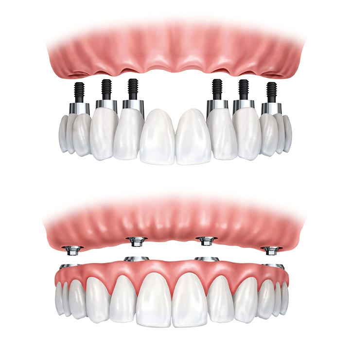 all-on-4-versus-traditional-dental-implants.jpg