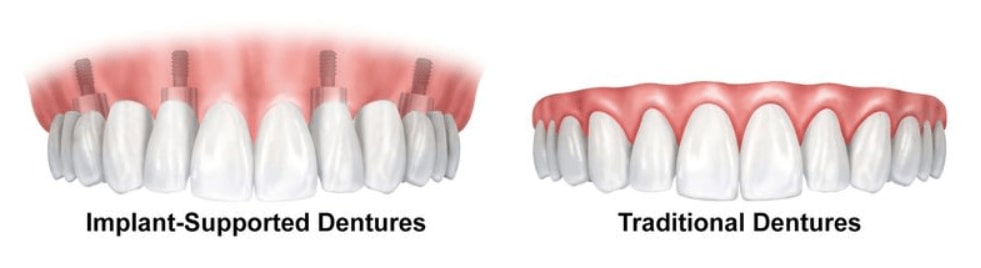 North Pier Dental offers traditional dentures and implant-supported dentures to replace missing teethville neighborhood