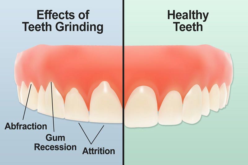 teeth-grinding-dental-damage.jpg
