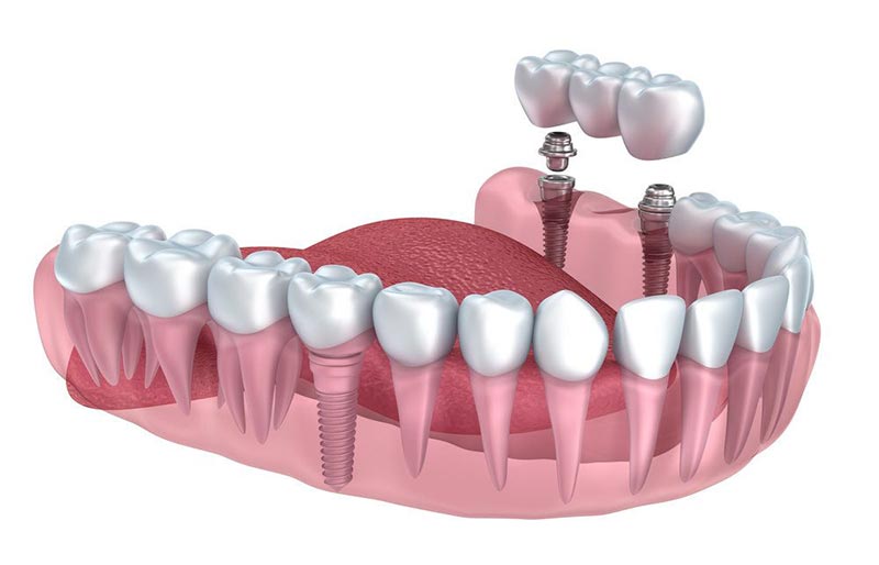 dental-implant-options.jpg