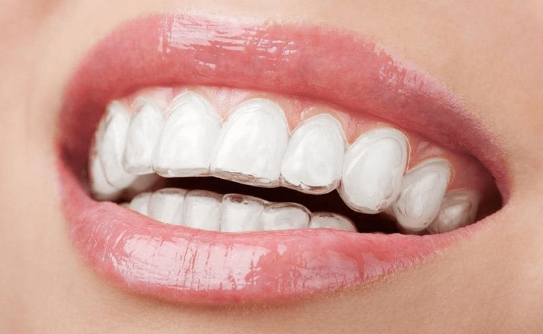 Cost Of Invisalign Chicago Streeterville