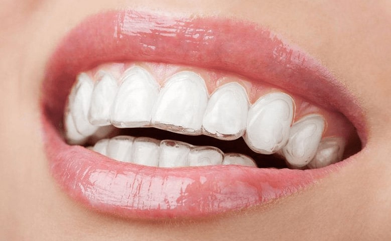 Cost of Invisalign Chicago Streeterville