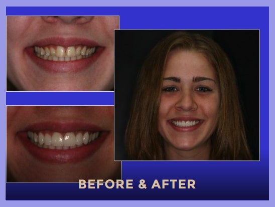 Before and after photos of dental veneers