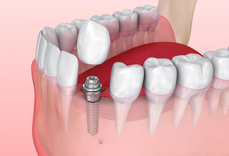 dental-implant-surgery-side-effects.jpg