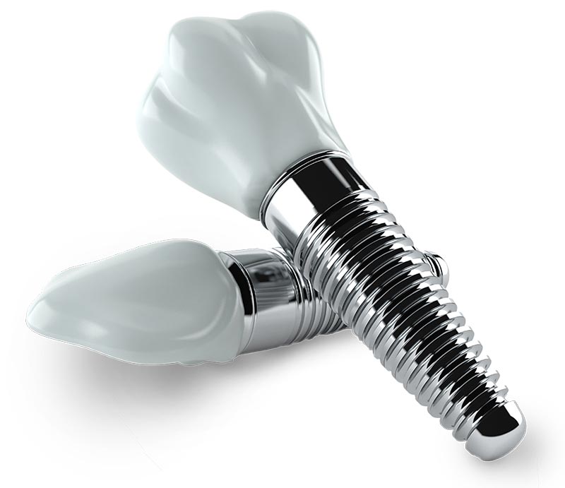 history-dental-implants.jpg