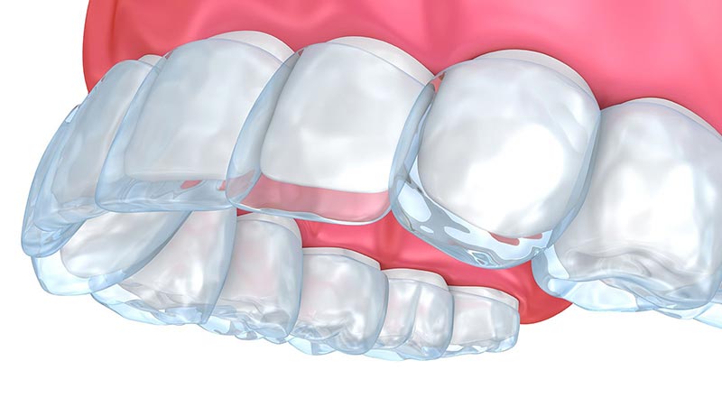 invisalign-treatment-timeline.jpg