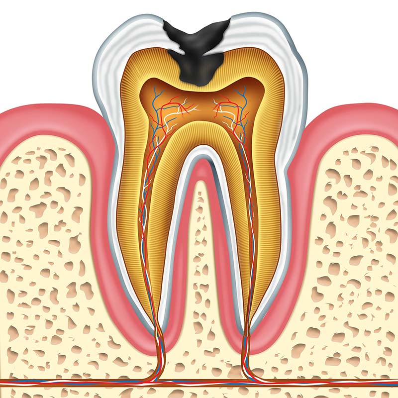 treatment-options-cavities-chicago-streeterville.jpg