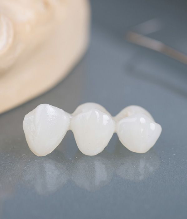 dental-bridges-vs-dentures.jpg