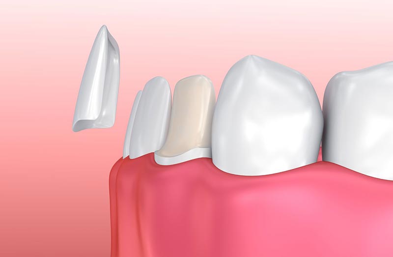 adjusting-to-porcelain-veneers.jpg