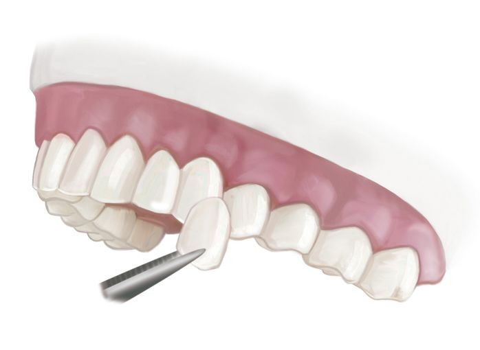 porcelain-veneers-instant-orthodontics.jpg