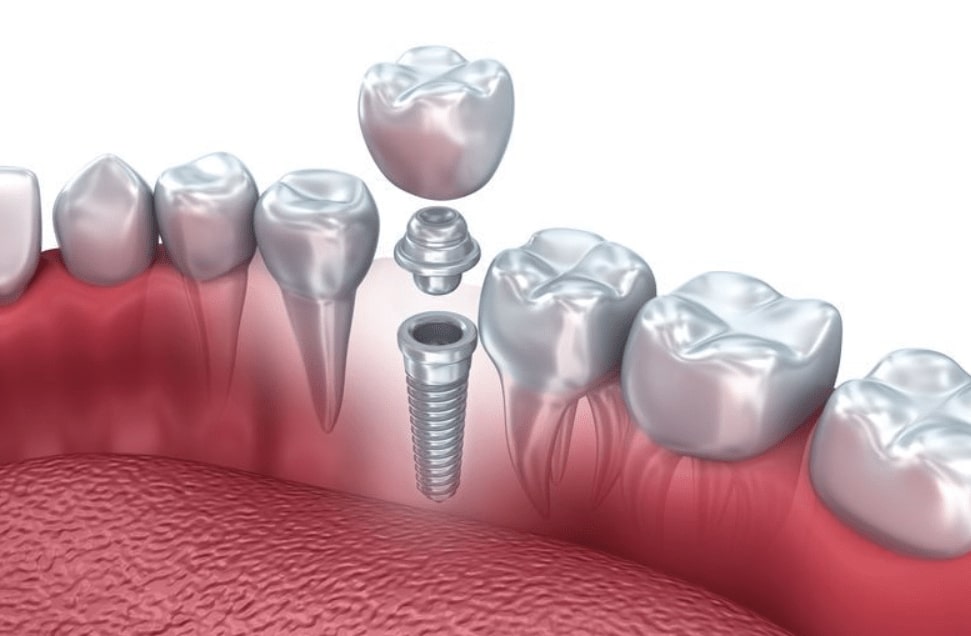 North Pier Dental offers dental implants at our Chicago dental clinic