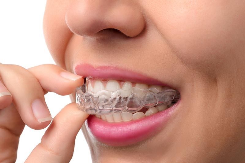 how-long-to-adjust-invisalign-aligners.jpg