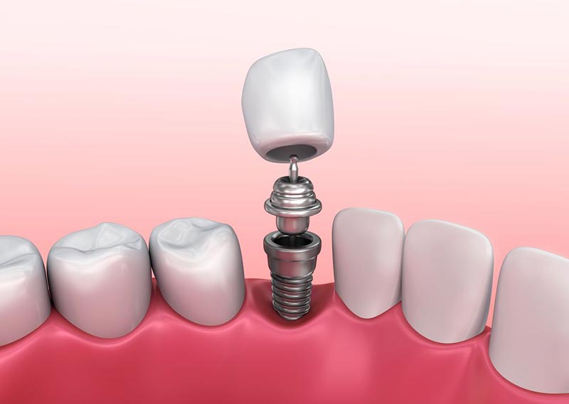 single-tooth-multiple-tooth-dental-implants.jpg
