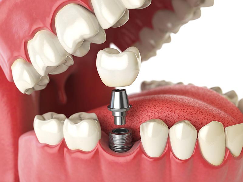 dental-implant-surgery-recovery.jpg