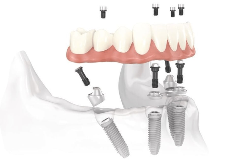 Dr. Couvelis at North Pier Dental offers All-on-4® Dental Implants at his Chicago dental clinic
