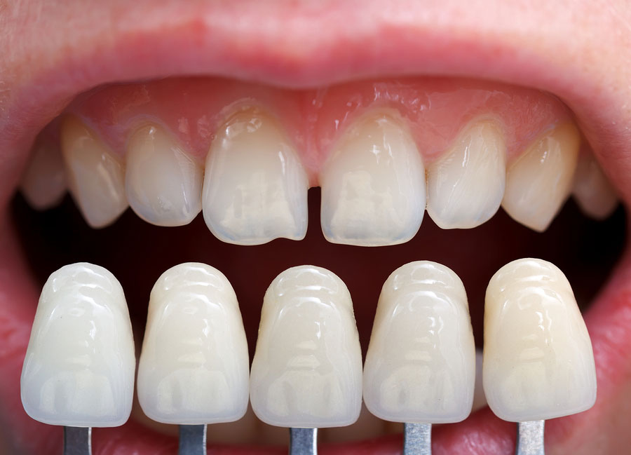 benefits-dental-veneers.jpg
