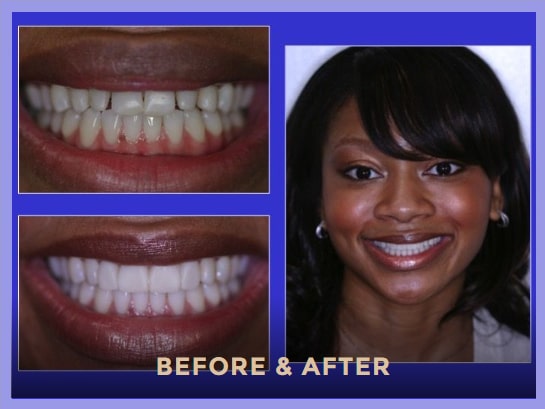 Dental veneers - before and after procedure photos